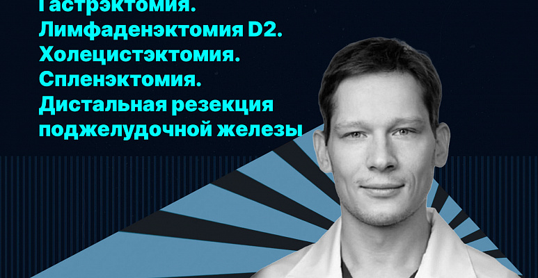Клинический случай. Лимфаденэктомия D2. Холецистэктомия. Спленэктомия. Дистальная резекция поджелудочной железы
